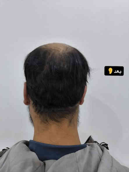 اذن بارزة نتيجه بعد شهر ونص
ب ايادي دكتور محمود احمد 

الـعنوان : ذي قار قضاء الشطرة مدخل حي المعلمين قرب صوره الحكيم
📲للحجز والاستفسار الاتصال
 على الرقم***********
