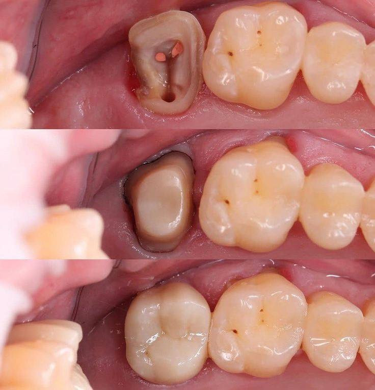 بعد اليوم لا وجع ولا تردّد ✨
حشوة ضوئية 20 ألف
حشوة جذر 20 ألف
تنظيف أسنان 15 ألف
قلع الأسنان 20 ألف
تبييض بالليزر + تنظيف 50 ألف

تراكيب ثابتة ومتحركة بأسعار تنافسية 🔥
خصم 50% لفترة محدودة 

للتواصل : ***********
