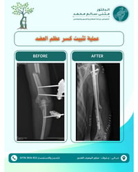 تثبيت كسر العضد • بدون فتح جراحي • جلولاء ديالى