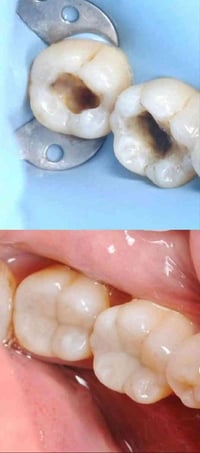 حشوات ضوئية • إعادة تفاصيل السن • مجمع اليمامة