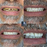 تغليف فكين زاركون • بالتقسيط • بسماية