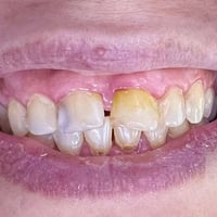 عروضنا وتخفيضاتنا مستمرة  تم اعادة الابتسامة والشكل الطبيعي للاسنان لم...