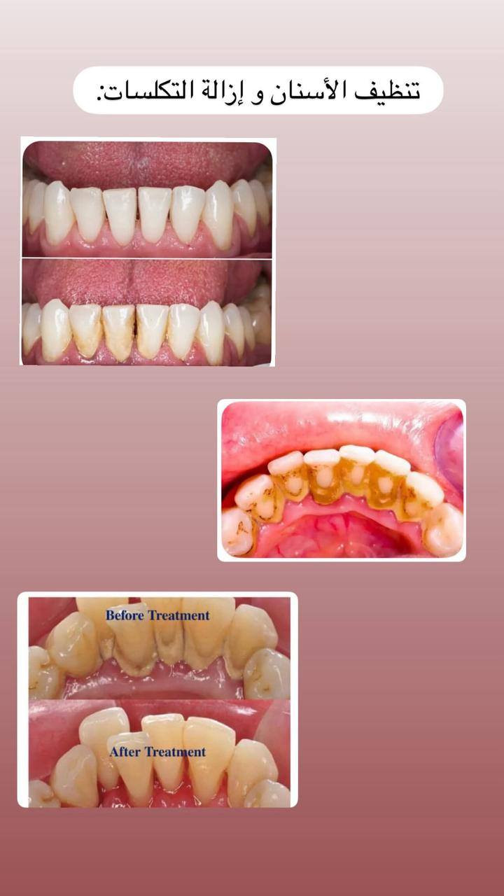 السلام عليكم .. مجاناُ مجاناُ
تعلن عيادات طب الاسنان في جامعة دجلة عن استقبال المراجعين لعلاج الحالات التاليه مجاناً  : 
● علاج الاسنان المتسوسة بالحشوات التجميليه.
● تنظيف الاسنان و ازالة التكلسات .
● قلع الاسنان و جذور الاسنان.
●تعويض الاسنان المفقودة بطقم جزئي متحرك .
العنوان : مستشفى طب الاسنان _ داخل جامعة دجلة.. 
للتواصل : هاتف ، واتساب ، تليكرام ‎***********
انستغرام : dr.fawz_mazin
