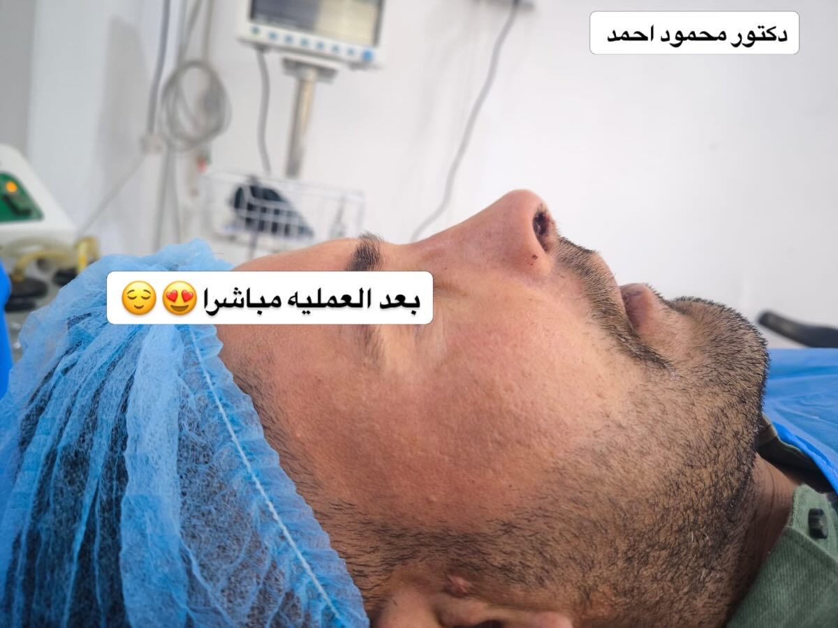 لماذا تختار هذا الإجراء 
​✅ تخدير موضعي: أمان عالي وفترة نقاهة أسرع.
​✅ إصلاح وظيفي وجمالي: تحسين التنفس وتعديل المظهر في آن واحد.
​✅ نتائج طبيعية: رسم الأنف بما يلائم تفاصيل الوجه.
​💰 السعر التنافسي: 600,000 دينار عراقي فقط!
​📍 العنوان: مركز الشرق الأوسط - قضاء الشطرة 
📞 للحجز والاستفسار: [‏078-132-88144‏ أو مراسلة الصفحة مباشرة.
​لا تدع الفرصة تفوتك.. مظهرك الجديد يبدأ من هنا!
​#تجميل_الانف #إصلاح_انحراف  #مركز_الشرق_الأوسط #الشطرة
