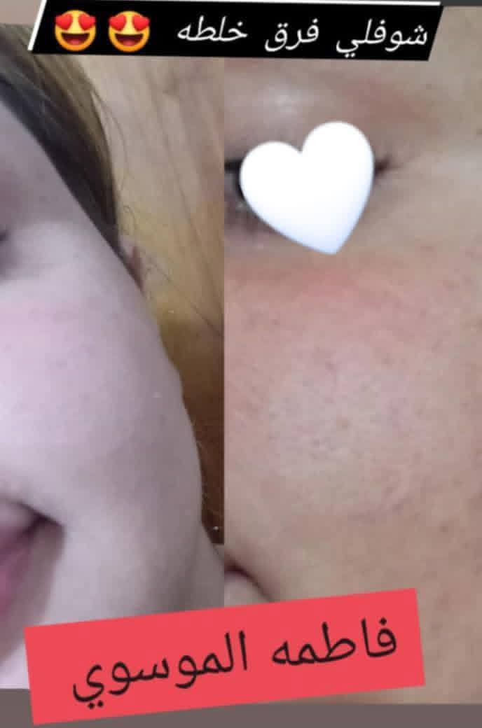 امانه الله تجارب حقيقه خلطتي تاخذها بضمان تبيض نضاره كلف نمش تصغبات حبوب اثار حبوب


**إذا كنت صاحب هذا الإعلان وتريد حذفه لأي سبب، رجاءا أرسل رسالة إلى الدعم الفني**