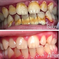 ✨ *نظّف أسنانك وخلّي ابتسامتك تتألّق!* ✨   في عيادة *سوانا* نقدم لك جل...