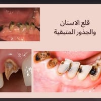 مرحبا اني دكتورة نبأ اذا احد عنده مثل هيج حالة يكدر يتواصل وياي والعلا...