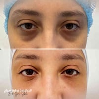 حقن شحوم ذاتية • نانوفات تحت العين • الدكتورة سارة صباح