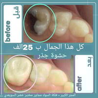 حشوة جذر • بدون ألم • المجر الكبير