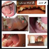 قلع سن مجاني • بقايا جذور • جامعة المنارة