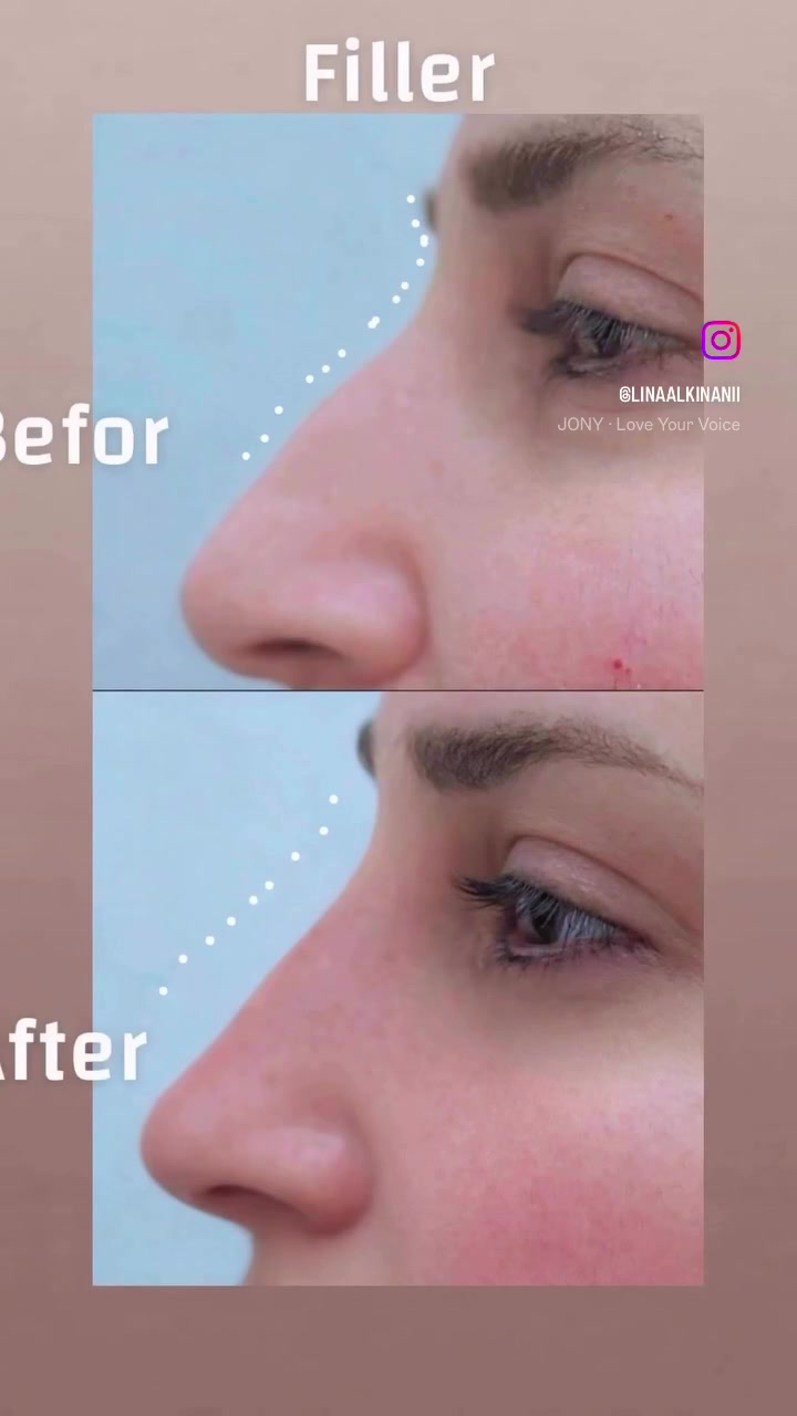 😍عرووووووض العيد 😍
😍 ✨ عيادة النبضة التجميلية ✨😍
لأن جمالج يستحق عناية بأدق التفاصيل 💉🤍

نوفر أحدث تقنيات التجميل اللاجراحي بأيدي خبيرة ونتائج طبيعية راقية ✨
🔹 حقن الفيلر
🔹 البوتكس
🔹 الميزوثيرابي
🔹 البلازما PRP
🔹 تفتيح ونضارة البشرة
🔹 جلسات الهيدرافيشل والعناية الملكية
🔹 علاج التصبغات والهالات
🔹 تحديد وكونتور للوجه والشفايف

نهتم براحتج، تعقيم عالي، وشغل ناعم يبرز جمالج بثقة وأناقة 💎

📍الموقع: بغداد – حي العامل-الجنابات -قرب روضة النسرين
🏥 عيادة النبضة التجميلية
***********

احجزي موعدج وخلي جمالج ينبض ثقة
