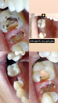 حشوة جذر • دكتور سجاد • سنتر الكوثر