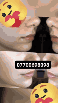 تبييض • رفع الكلف • ازالة حبوب