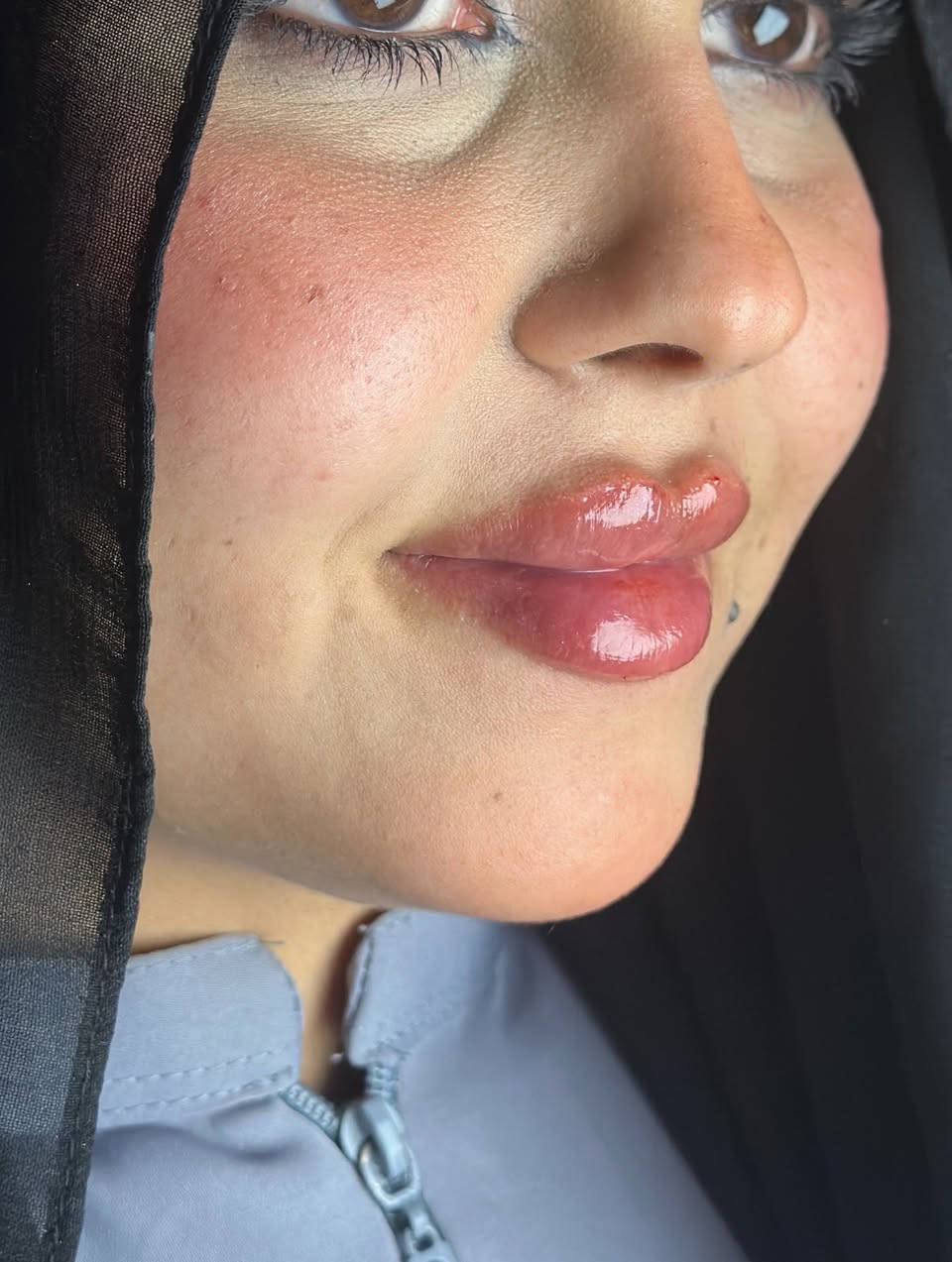 اكو احلى من هيج جمال بالحقن🙂‍↔️🔥🔥
الدكتورة ساره عدنان 💉
للحجز والاستفسار الاتصال المباشر للرقم :***********
