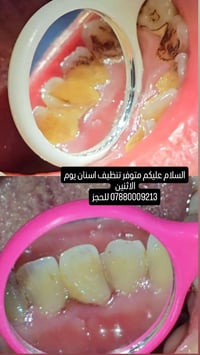 الي محتاج تنظيف اسنان او يعرف احد يريد يراسلني للحجز 07880009213