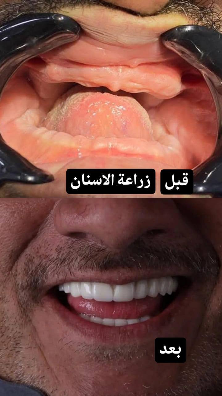 ✨ عروض مميزة على جميع خدمات طب الأسنان… ابتسامتك بأفضل سعر!
🦷 ابتسامة صحية بأسعار رمزية لا تفوت الفرصة!
💎 خصومات خاصة على تنظيف وتجميل الأسنان لفترة محدودة!
🌟 لأن ابتسامتك تهمنا… نقدم لك أفضل العروض بأعلى جودة!
🔥 عروض حصرية على علاجات الأسنان… احجز الآن وابتسم بثقة!

عيادة الارجوان لطب الاسنان/ سبع البور شارع الاربعتالاف 4000 ضمن مجمع دكتوره ديانا الزبيدي
واتساب ***********
