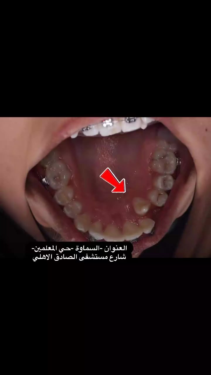 نبأ الشمري ✨ لأن صحتك وجمالك يستاهلون الأفضل ✨
تقدم لكم عيادة [الضياء سمايل]
أفضل الخدمات الطبية والتجميلية بأحدث الأجهزة وعلى أيدي مختصين 💉🌸
✔️ استشارات طبية دقيقة
✔️ جلسات تجميل وعناية بالأسنان
✔️ نتائج مضمونة واهتمام بأدق التفاصيل
📍 الموقع: [السماوه حي المعلمين مقابل نيكست لفل]
📞 للحجز والاستفسار: [***********]
💖 راحتك وثقتك بين إيدينا 💖

https://www.instagram.com/dr.riyam_alyasiri?igsh=N2xva2FtOHNpNXpi
