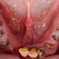 ای شخص محتاج قلع اسنان او جذور تالفه أو طقم متحرك يتواصل وياي وبشكل  م...