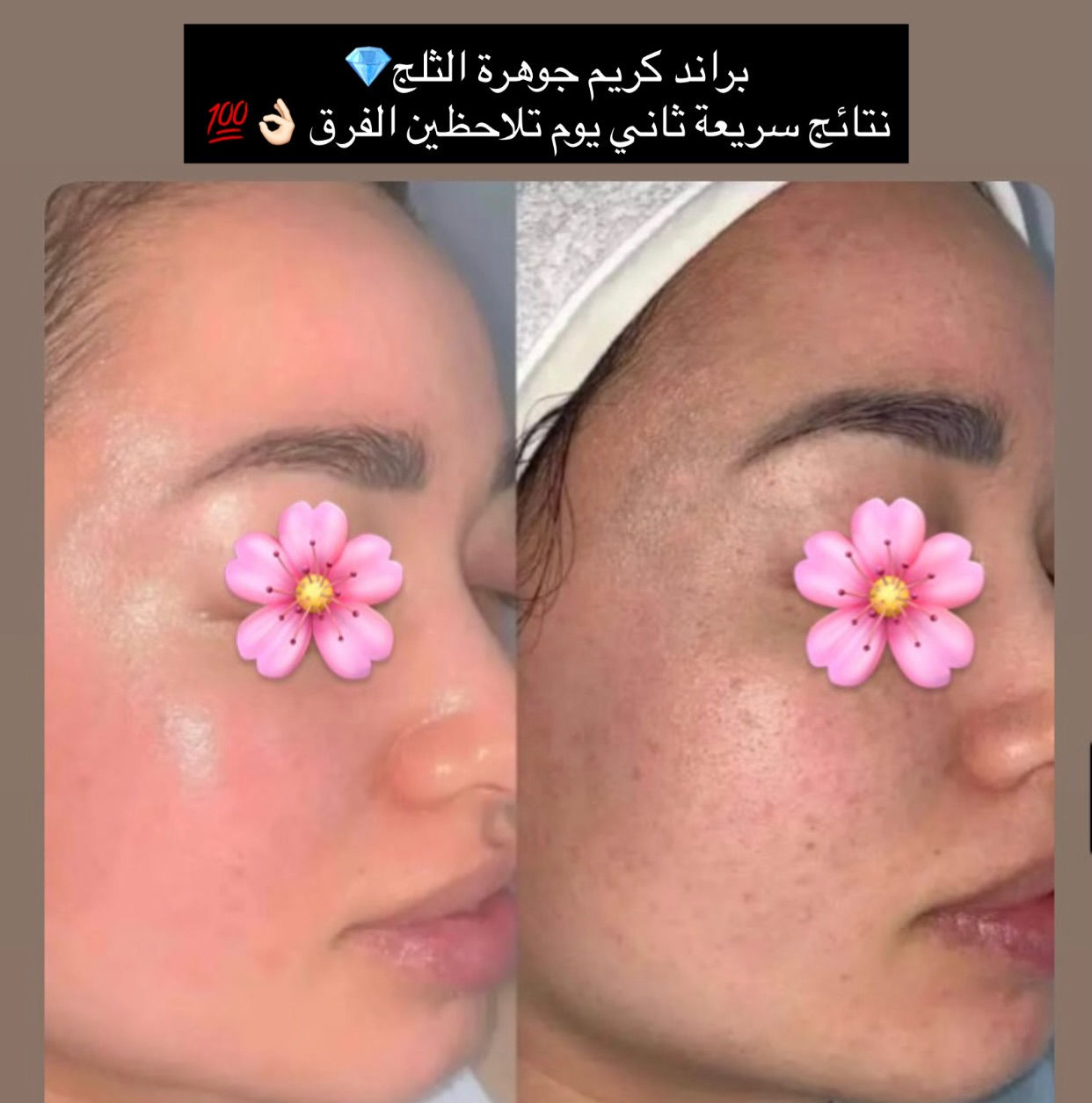 كريم وسيروم براند جوهرة الثلج💎❄️
نتائج ممتازة خلال ثاني يوم تحسين بفرق كبير ع بشرتج
(تبييض البشرة - ازالة الكلف - ازالة النمش _ازالة التصبغات)
فوائد السيروم (منتج كوري بالماء الأرز يغنيج عن إبرة النظارة-ترطيب
ونعومة- ويحفز الكولاجين) 

السعر 20,000 مع التوصيل🥰


**إذا كنت صاحب هذا الإعلان وتريد حذفه لأي سبب، رجاءا أرسل رسالة إلى الدعم الفني**