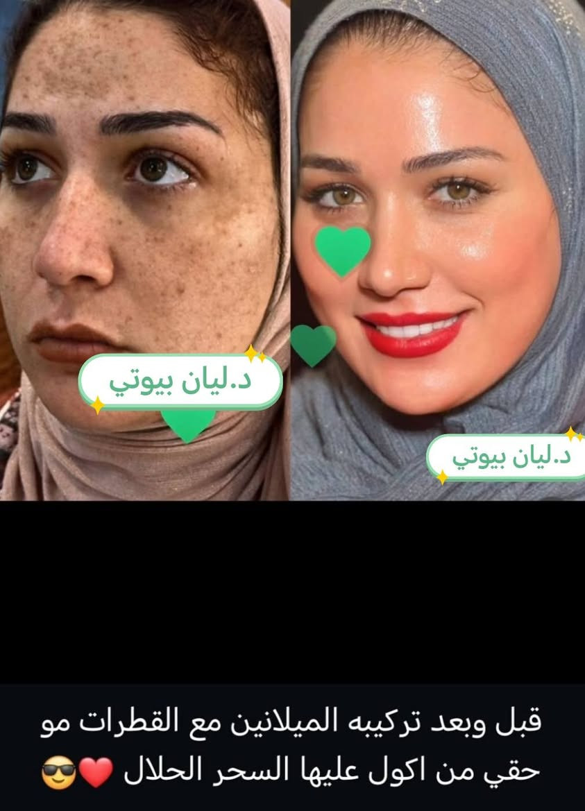 🎉🔥 عرض العيد من د.ليان بيوتي  🔥🎉
بمناسبة العيد حبايبي 💕
كل البكجات ✨ التركيبات ✨ وكل المنتجات
بس بـ 20 ألف وبس 😍
🚚 التوصيل 3 آلاف لكل المحافظات
لا تفوتج الفرصة 💄✨
جددي بشرتج وشعرج قبل العيد وخلي طلتج غير 💖
العرض لفترة محدودة… احجزي هسه قبل لا يخلص 🔥
الجميع


**إذا كنت صاحب هذا الإعلان وتريد حذفه لأي سبب، رجاءا أرسل رسالة إلى الدعم الفني**