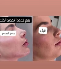 عرض سحب وجنة فلر شفه صدغ خطوط ضاحكه ذقن تكساس تحديد فك تقويم الأنف ورف...