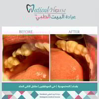 ترميم سن • تاج سيراميك • المحمودية حي الموظفين