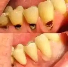 📌 إعلان من عيادات طب الأسنان 📢

يسر عيادات طب الأسنان في كربلاء المقدسة أن تعلن عن استقبال المراجعين مجانا بإشراف كادر تدريسي ومتخصص من أطباء الأسنان.

🦷🩺والخدمات المجانية تشمل:

✨فحص وتشخيص الأسنان واللثة

✨الحشوات التجميلية الضوئية

✨تنظيف الأسنان وإزالة الجير والترسبات

✨قلع الأسنان والجذور والأسنان التالفة

✨عمل التركيبات السنية الأطقم والجسور

📌 الموقع كربلاء المقدسة - شارع الحر - عيادات جامعة اهل البيت

🕣 أوقات المراجعة من الساعة 8:30 صباحاً حتى 1:00 ظهراً خلال أيام الدوام الرسمي

📞📱للتنسيق والحجز • عبر الاتصال أو الواتساب على الرقم ***********

https://wa.me/9647830340502?text=سلام%20عليكم%20دكتور...%20اريد%20احجز
