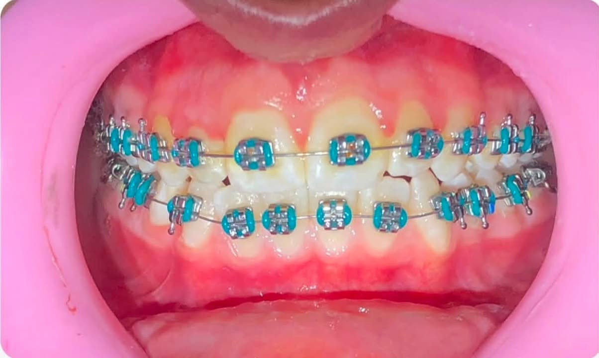 🦷 نتيجة تقويم الأسنان بعد شهرين فقط! ✨
والعلاج مستمر
مع د. عبدالوهاب حازم  (تقويم وزراعة الأسنان )

💳 يتوفر نظام التقسيط

📍 العنوان: الحود – الشارع العام
📞 للحجز والاستفسار: ***********
