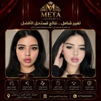 الموصل ايسر • فلر • ميتا لاكجري