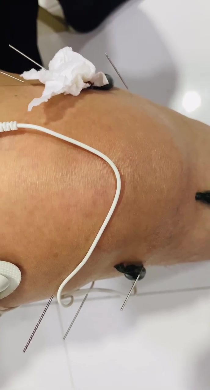 يعتبر العلاج بالعلق الطبي.. وسيلة فعالة في الطب البديل لتخفيف آلام مفصل الركبة وتحسين وظائفه، خاصة في حالات هشاشة العظام والالتهابات. تكمن فاعلية هذا العلاج في "اللعاب" الذي تفرزه دودة العلق أثناء امتصاصها للدم، حيث يحتوي على مواد نشطة بيولوجياً تعمل كمسكنات طبيعية ومضادات للالتهاب. 
 📍واسط _ النعمانية /شارع 13
📞للحجز والاستفسار ***********
المصطفى للحجامة و الطب البديل
#الحجامة_النسائية
#مفاصل #سوفان الركبة #دودة العلق
