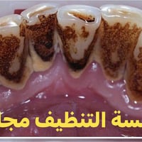 تنظيف مجاني • تكلسات أسنان • عيادات الصفوة