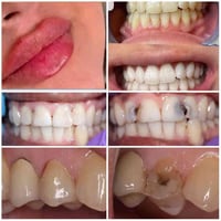 خصم 50% • زاركون إيماكس • تنظيف وتبييض