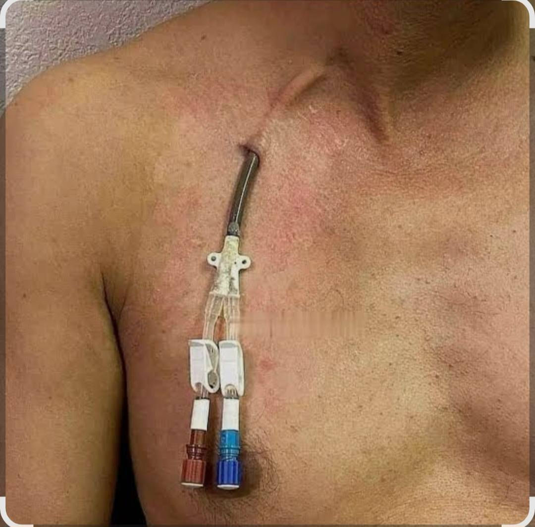 للبيع دبل لومن بارد و كوفيدن او ما يعرفن بجهاز غسل الكلى دائمي والثاني مؤقت ماخذهن المريضي بسعر 700 الف اليريدهن  نتوالم عليهن ايراسلني او يتصل على ***********
