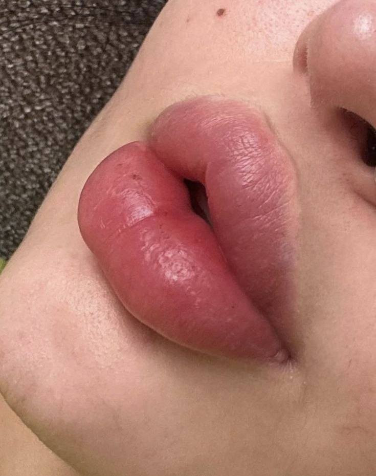 فلر الشفاه (بديل الفلر):
قطرات بسيطة لمدة 3 دقائق فقط، وشوفي حجم شفايفك شلون يتغير! 👄 تحفيز طبيعي للدورة الدموية يعطيكِ امتلاء وتوريد خيالي 😍


**إذا كنت صاحب هذا الإعلان وتريد حذفه لأي سبب، رجاءا أرسل رسالة إلى الدعم الفني**