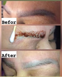 جلسة ازالة بالفيريموفل PhiRemoval المادة الوحيدة يلي بتشيل التاتو بعدد...