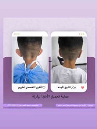 تجميل الأذن • د محمود أحمد • ذي قار الشطرة