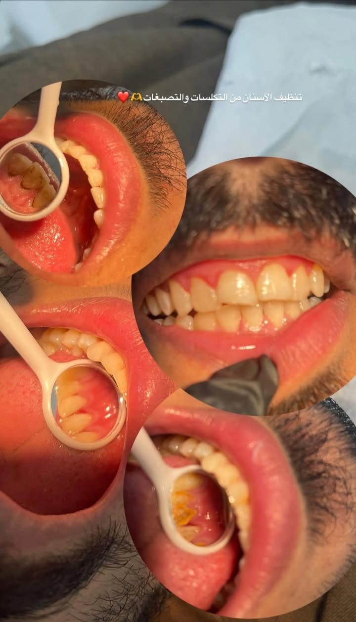 خدمة طبية مجانية لأهلنا في منطقة الحر وكربلاء 🦷 

تنظيف الأسنان وإزالة الكلس والتصبغات (مجاناً بالكامل).

✅ فحص شامل للأسنان وتقديم الاستشارة الطبية.

المكان: عيادات جامعة أهل البيت - طريق كربلاء/الحر 

📞 للحجز والاستفسار (واتساب أو اتصال): [***********]

ملاحظة: العمل دقيق ومضمون، والهدف هو الفائدة العامة وإكمال المتطلبات الدراسية 

فريق خاص للاشراف على العمل واجهزة خاصة لتعقيم المواد ب ايدي فريق متدرب 

نماذج من شغل داخل عيادتي ⏬️
