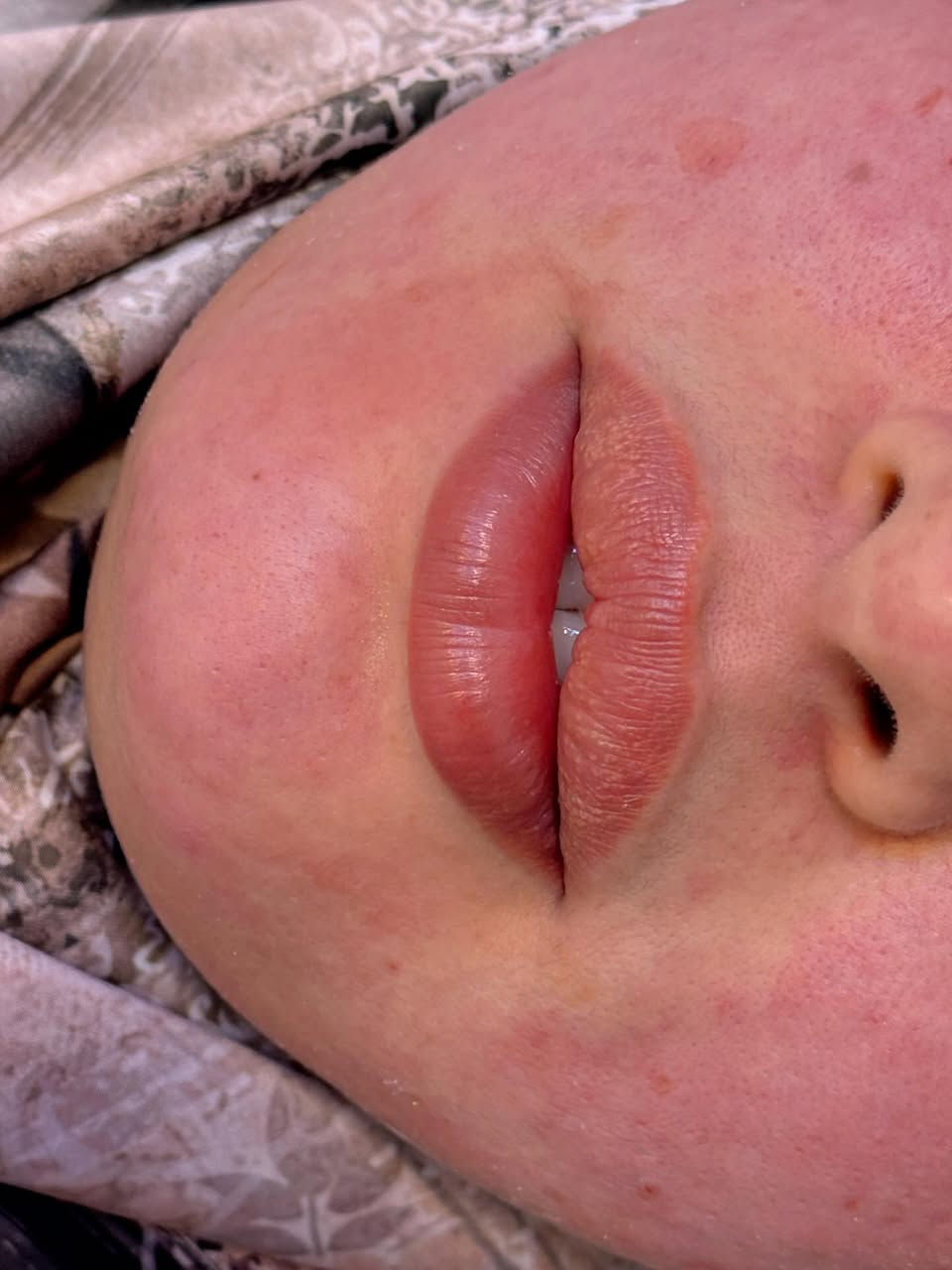 ⁨ الرسمة من بعد ١١ شهر ولا غلطة ❤️‍🔥🫶🏻
📍📍عيادة بيرلي (نبتون)
الحمزة الشرقي جهة شارع الملاحة مقابيل صيدلية نجلاء الشيباني 
واتساب او الاستفسار ***********
#الحمزة_الشرقي #الديوانية #الحمزه_الشرقي #عيادة_بيرلي_نبتون #فلر_شفايف #فلرشفة_فلر_وجنات_فلرخطوط_ضاحكة_فلرذقن_تكساس_تكنيك❤️❤️❤️⁩⁩
