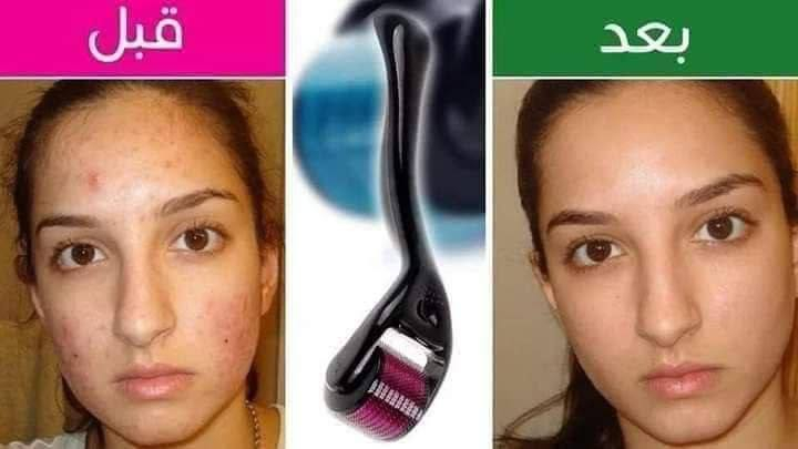 ديرما رول Derma Roller

درمارول اداة طبية تستخدم لازالة تجاعيد الوجه 
واثار حب الشباب القوية وايضا المسامات 
وخطوط التمدد البيضاء والحمراء واثار الحروق .

الديرمارول آلية عمل ديرما رولر :
تحفز ديرما رولر الكولاجين الطبيعى الموجود 
فى بشرتك مما يجدد البشرة ويعطيها 
مظهر رائع وجديد باسرع وقت 
وباقل مجهود وتكلفة .

شكل الديرما رولر :
رأس ديرما رولر يشبة البَكرة وتحتوى هذة البَكرة 
على مئات الابر الصغيرة والدقيقة وهى التى 
تعمل على تحفيز انتاج الكولاجين اما باقى الجسم 
فهو عبارة عن يد طويلة ذو تصميم انسيابى 
لتمكنك من استخدامها بسهولة .

تعالج ديرما رولر :
• ندبات حب الشباب Acne Scars .
• المسامات الكبيره Large pores .
• خطوط التمدد البيضاء والحمراء Stretch Mark باليدين والأفخاذ والأرداف والبطن بعد الحمل والولاده والسمنة .
• ازالة السلولايت cellulite .
• التجاعيد wrinkles .
• تساقط الشعر او فروة الرأس المصلعه hair loss .
• ازالة آثار الحروق والجروح واثار التعرض للشمس .
• بهتان البشرة وفقدان بريقها الحاصل من قلة وجود الكولاجين بالبشر
#الاصلية 💯 
السعر 8 الاف 
🚘 يوجد خدمة توصيل لجميع محافظات العراق 4 الاف 🚘
#اكسبلور #العراق


**إذا كنت صاحب هذا الإعلان وتريد حذفه لأي سبب، رجاءا أرسل رسالة إلى الدعم الفني**
