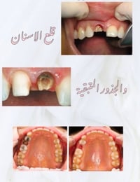 الي محتاج قلع اسنان  (مجانا) عنده جذور  او اسنان تالفه يريد يقلعها  (ب...