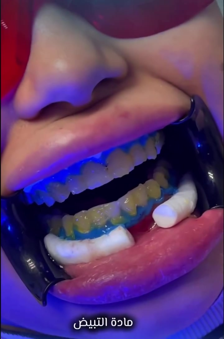 عيادة الطائي لطب الاسنان ♥️

تنظيف وتبيض الاسنان وبجلسات متقنة جداً راح تلاحظ الفرق من اول جلسة ✅

عيادة الطائي لطب الاسنان

تواصل ويانا *********** 

أو على الرقم *********** 

#سبعالبور
#التاجيات
#التاجي
#سبع_البور
