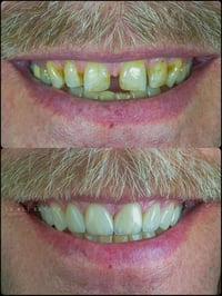 يعلن مختبرات السوري للاسنان 😍🦷🦷🦷🦷🦷🦷 عن تخفيضات تصل 50% عن جميع انواع ا...