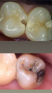 تسوسات أسنان • علاج مجاني • بعقوبه تقاطع القدس