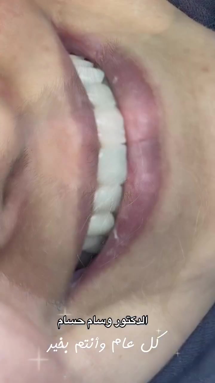 ابتسامات العيد في مركز الشام 🔥😍
ابتسامة العيد تبدأ بخطوة وحدة!
احجز موعدك ويانه وخلي شغلك يطلع مرتب، طبيعي، ويخطف النظر 😍🦷

📞 للحجز والاستفسار: ***********
📍 مركز الشام الطبي – عيادة الدكتور وسام
قضاء الحي / واسط – قرب مركز الشرطة القديم

لا تأجل ابتسامتك 🤍
