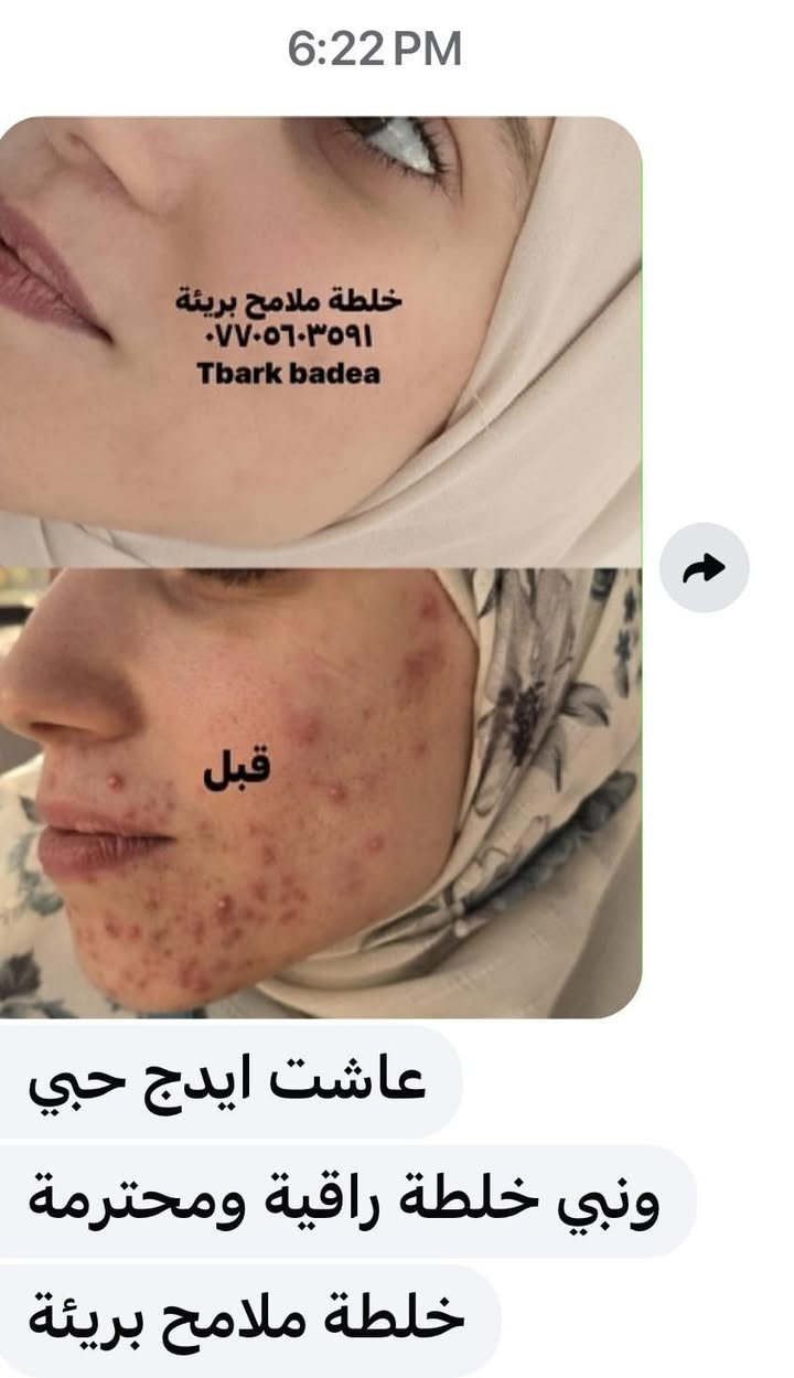 شمنتضرة ؟؟عالجي بشرتج 🥰
سارعي بالحجز 😘
وبرزي جمالج وملامحج الطبيعية ببشرة  خاليا من التصبغات والكلف والنمش والتجاعيد والحبوب وآثار الحبوب 🌹


**إذا كنت صاحب هذا الإعلان وتريد حذفه لأي سبب، رجاءا أرسل رسالة إلى الدعم الفني**