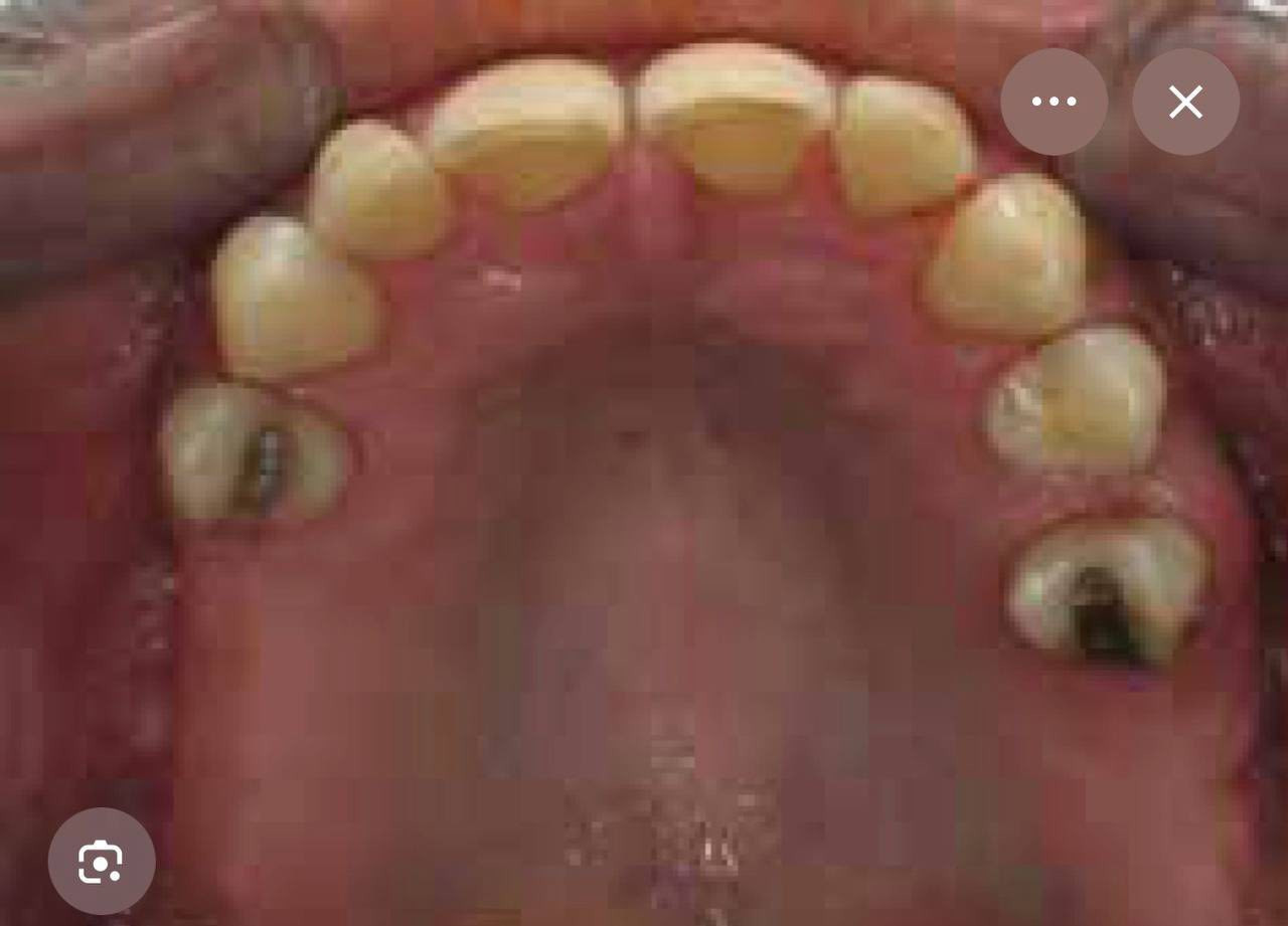 مجاناً … مجاناً … مجاناً
السلام عليكم ورحمة الله وبركاته …

الى جميع الاخوة الذين يعانون من الحالات المرضية في الصورة ادناه ويرغبون في العلاج او تعويض للاسنان الخلفية حصرا وبشكل مجاني ..

علماً ان العلاج مجاني وتحت اشراف اطباء اختصاص ماهرين ..

العنوان :- 

عيادات جامعة المشرق _شارع مطار بغداد_مقابل تمثال عباس بن فرناس ..

للاستفسار واتساب على الرقم 

***********     

مع جزيل الشكر والامتنان ..
