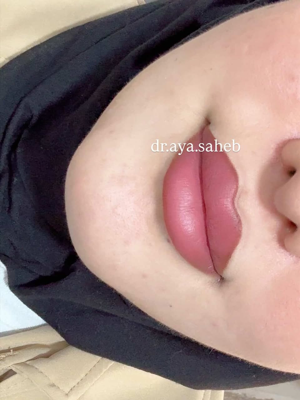 مجموعة صور مختلفة من مراجعاتي بعد حقن فلر الشفة ♥️ صورة احلى من صورة 🍬😍
للحجز والاستفسار/***********
الديوانية 📍
