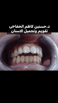 حالة تقويم  اسنان لأحد المراجعين يعاني من تقديم الأسنان الأماميه والعضه المفتوحه (open bite)تم معالجتها بالتقويم الثابت /عيادات الحسنين لتقويم الأسنان والتجميل الحمزه الشرقي شارع الأطباء مقابل صيدلية آحمد علي ***********
