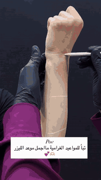 بنات، مهم تعرفون إن الليزر ما يبين من أول جلسة… لأن الشعر يمرّ بمراحل نمو مختلفة، ولهذا نحتاج ناخذ الجلسات بوقتها.
كل جلسة تستهدف جزء من الشعر اللي يكون بمرحلة النمو، وبالالتزام نضمن تغطية كل المراحل ونوصل لأفضل نتيجة.
كل ما انتظمتِ—كل ما شفتي نعومة، تفتيح، وقلّة واضحة بالشعر.
الليزر مو جلسة وحدة… هو رحلة، والالتزام هو السر ✨»
العنوان: المحمودية حي الموظفين مجاور مول هبي دي فوق مختبر اليوسف((( بالطابق الثاني)))
في مدخل العمارة علوة المصطفى للخضروات والفواكه 📍((((كاترينيا كلينك)))))📍
‏For Booking:

  *********** 
*********** 
***********

#اكسبلور_فولو #المحموديه #بغداد#اكسبلور_فولو #المحمودية #اكسبلور_explore #المحمودية⁩⁩⁩#اكسبلور_فولو #بغداد
