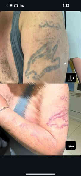 ازالة وشم من عياده سنايا
كربلاء - الجمعية
رقم الحجز ***********
